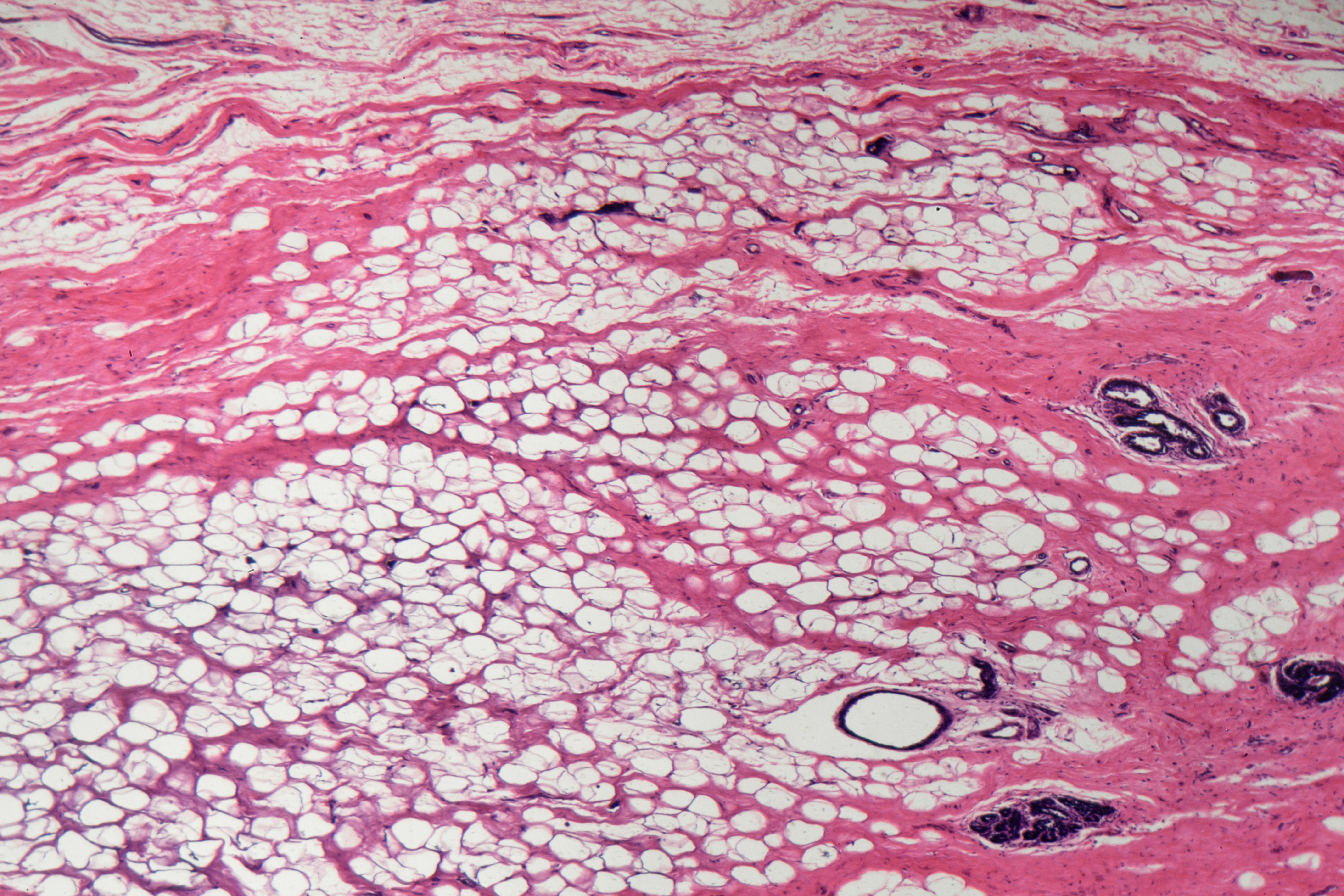 Haun evaluated the new microfluidic tissue dissociation platform on a diverse array of tissue types, such as kidney, breast (pictured), liver and heart. Single cell analysis of tissue holds the potential to change the way we search for powerful new drugs and treat patients with a more personalized approach.